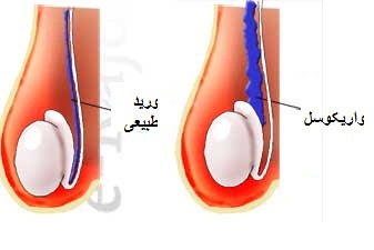 واریکوسل